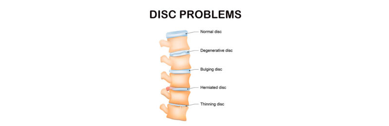 Disc problems treated with Chiropractic in Margate Florida